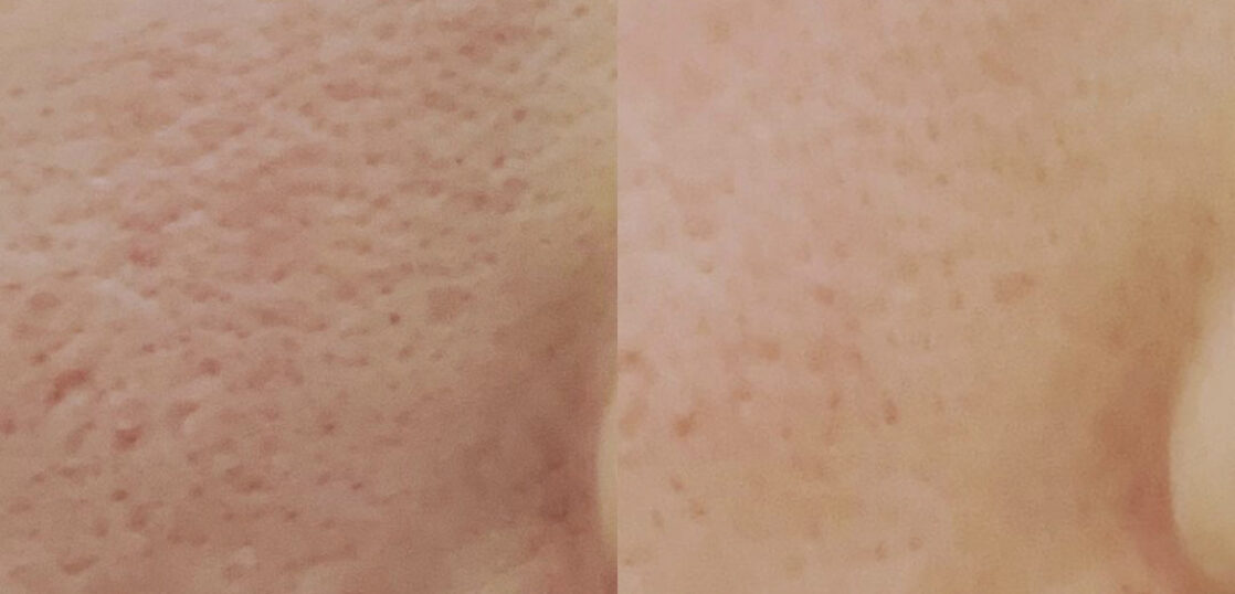 毛穴の開きに対する幹細胞治療 ニキビ跡 クレーター 治療情報