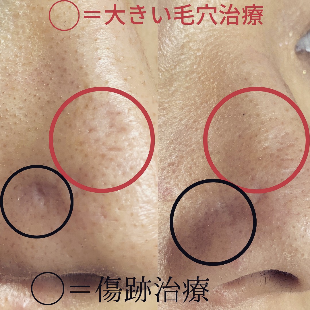 傷あと治療