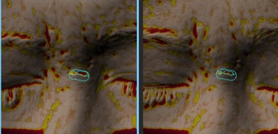 眉間に出来たニキビ跡の凹みに対する幹細胞治療