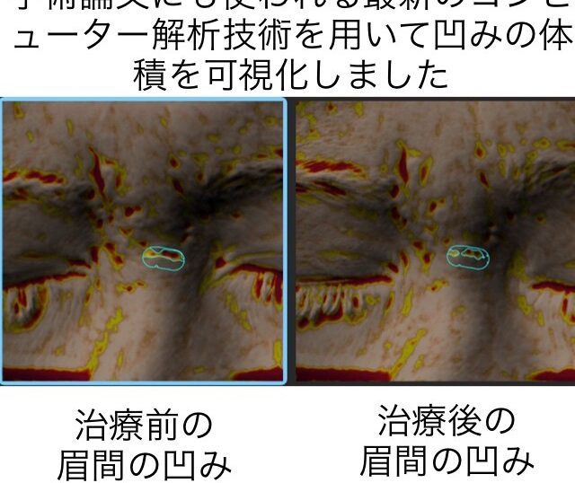 眉間に出来たニキビ跡の凹みに対する幹細胞治療