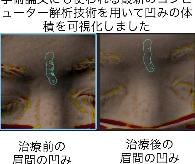 眉間に出来たニキビ跡の凹みに対する幹細胞治療