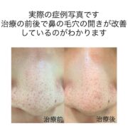 鼻の毛穴に対する幹細胞治療