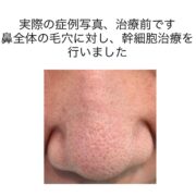 鼻全体の毛穴に対する幹細胞治療