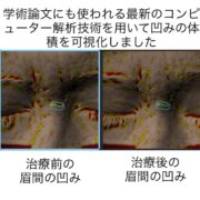 ニキビ跡による眉間の凹み