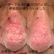 鼻の凹凸に対する幹細胞治療