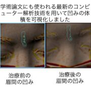 ニキビ跡による眉間の凹凸に対する幹細胞治療