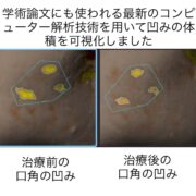 ニキビ跡による頬の凹凸に対する幹細胞治療