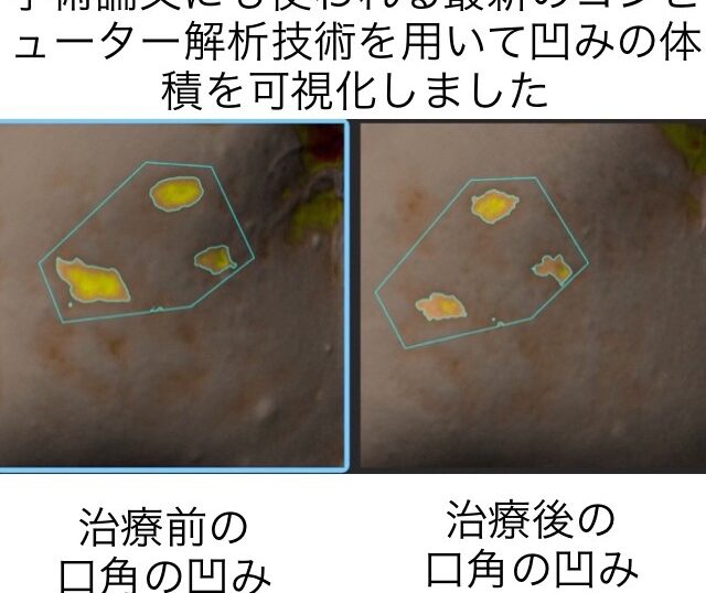 ニキビ跡による頬の凹凸に対する幹細胞治療