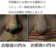 鼻の凹み