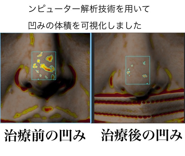 鼻の凹み