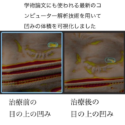 二重切開の傷跡に対する幹細胞治療②