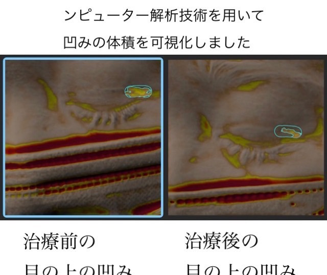 二重切開の傷跡に対する幹細胞治療②