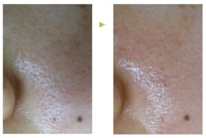 最新毛穴治療 世界のセレブも来院する幹細胞手術 東京銀座クリニック