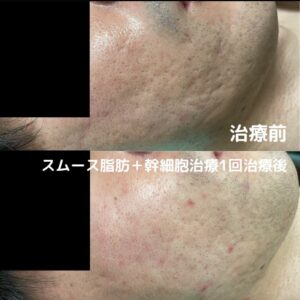 最新ニキビ跡治療 皮膚再生 幹細胞治療 東京銀座クリニック 最新ニキビ跡治療 皮膚再生 幹細胞治療 東京銀座クリニック