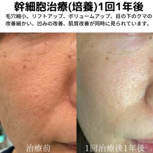最新ニキビ跡治療 皮膚再生 幹細胞治療 銀座 東京中央クリニック 最新ニキビ跡治療 皮膚再生 幹細胞治療 銀座 東京中央クリニック